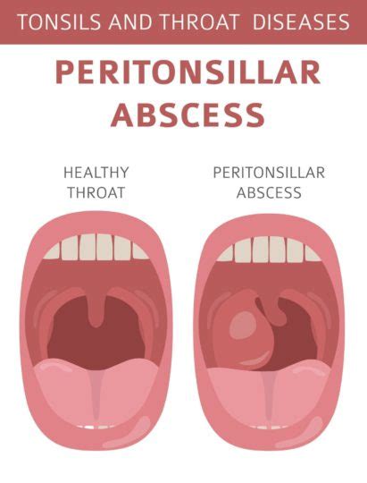 Pathophysiology Of Peritonsillar Abscess