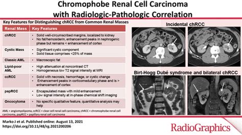 Chromophobe Renal Cell Carcinoma With Radiologic Pathologic Correlation