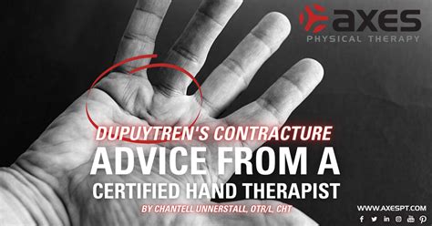 Advice From A Certified Hand Therapist Dupuytrens Contracture Axes