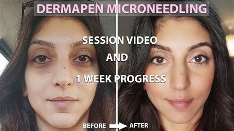 Dermapen Microneedling Before And After Process 1 Week Amazing