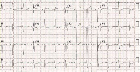 Pr Interval Prolongation In A Patient With Infective Endocarditis
