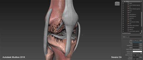 Osteoarthritis Severe Condition Knee 3d Model Turbosquid 1410244