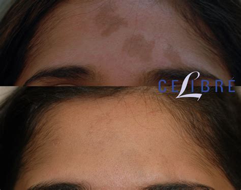 Birthmark Removal Before And After Pictures