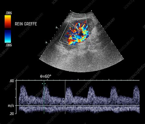 Transplanted Kidney Doppler Ultrasound Stock Image M1950143