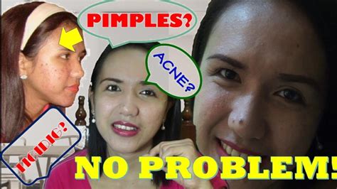 Ano Ang Mabisang Pantanggal Ng Pimples Tigyawat Acne Based On Real