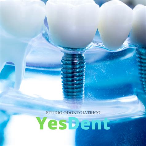 Implantologia A Carico Immediato Studio Dentistico Yesdent Dentisti