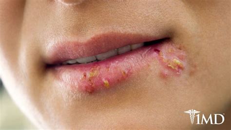 Cold Sores The Causes And Symptoms How To Prevent And Treat Them 1md