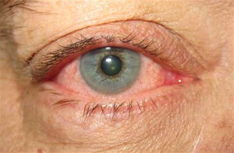 Die virale konjunktivitis geht häufig mit erkältungskrankheiten einher, die häufigste ursache sind sogenannte adenoviren. Acute conjunctivitis - Symptoms, diagnosis and treatment ...