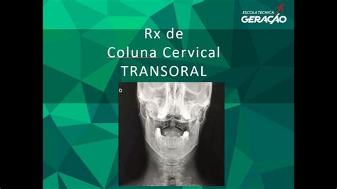 Radiografia Da Coluna Cervical Transoral Youtube