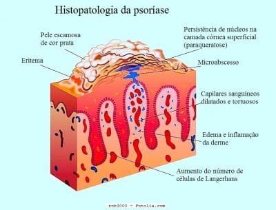 18% dos pacientes•psoríase moderada : Psoríase no couro cabeludo e no rosto, no ouvido ...