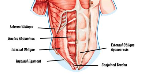 Inguinal Disruption Gilmores Groin Symptoms Causes Treatment And Surgery