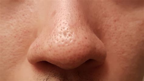 scarred pores on nose joining together at a loss scar treatments