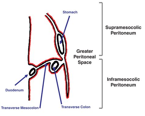Mri Of The Peritoneum Spectrum Of Abnormalities Ajr