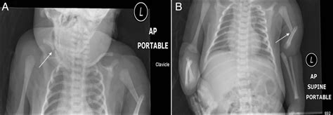 Bilateral Fractures In A Shoulder Dystocia Delivery Bmj Case Reports