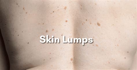 Skin Lumps Alpine Surgical Practice Colorectal Surgeon Lipoma