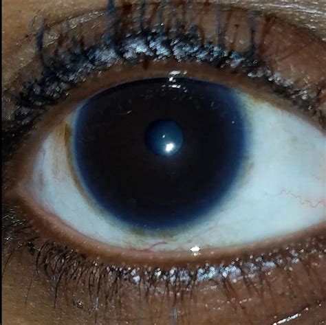 i have had a light blue ring around my dark brown eyes since birth what could be the reason for