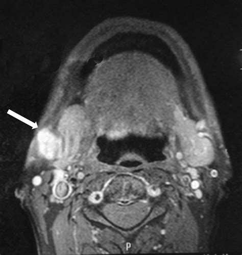 Pleomorphic Adenoma Of An Accessory Submandibular Salivary Gland A