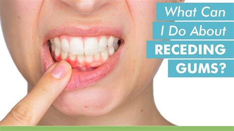 What Can I Do About Receding Gums Youtube