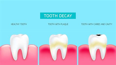 Tooth Decay Transcend Dental Care Orlando Dentist