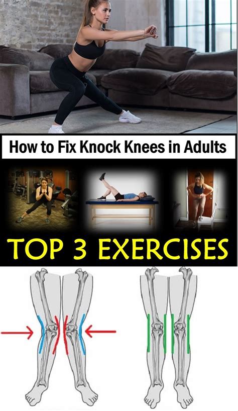 How To Fix Knock Knees In Adults Knock Knees Knock Knees Exercises
