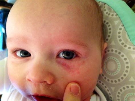 Opinions Please Redness Around Los Eye Changing Pediatricians