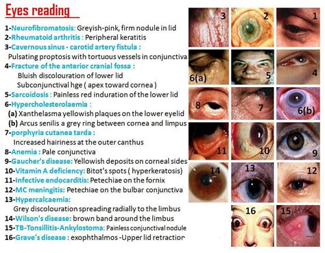 Helps Diagnosis Some Eye Disorders With Signs General Knowledge