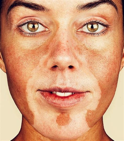 Brock Elbank El Fotógrafo De La Piel Retrata Ahora La Belleza De Personas Con Vitiligo