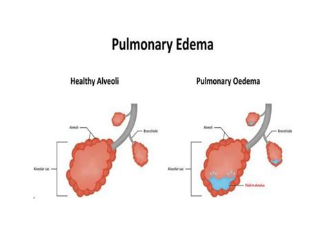 Solution Pulmonary Edema Studypool