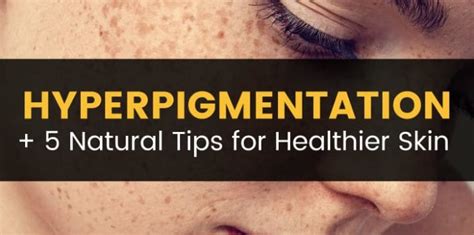 Hyperpigmentation Therapies Plus 5 Natural Skin Care Tips Dr Axe