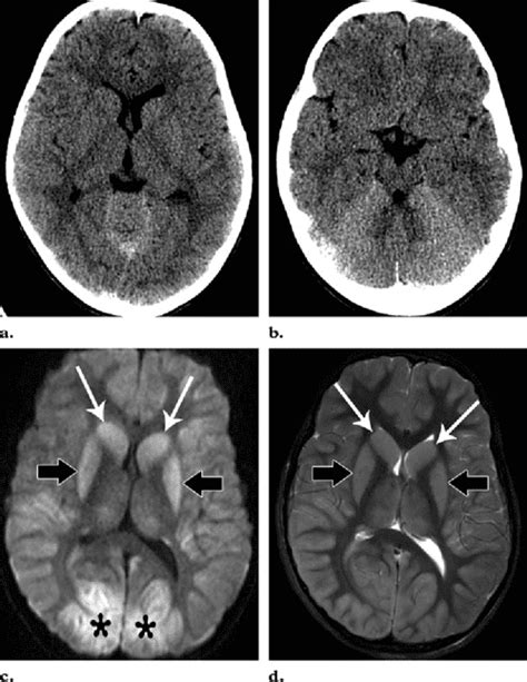 Figure 12 From Hypoxic Ischemic Brain Injury Imaging Findings From