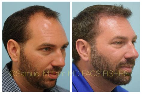 This 42 Year Old Male Is Shown Before And After Hair Restoration