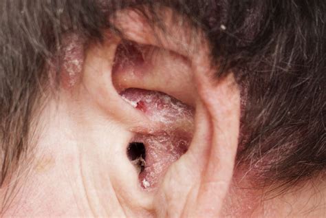 Psoriasis In Ears Symptoms Causes And Treatment
