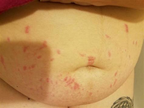 Non Itchy Red Bumps On Pregnant Belly Pregnantbelly
