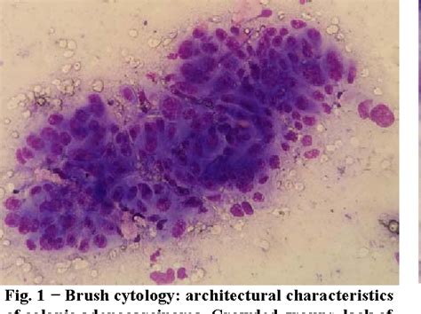 Figure 2 From The Value Of Brush Cytology And Biopsy For The Diagnosis Of Colorectal Cancer
