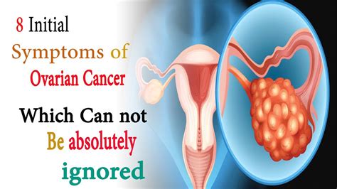 Stages Of Ovarian Cancer Symptoms Initial Symptoms Of Ovarian