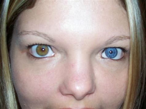 Complete Heterochromia With Sectoral Heterochromia Heterochromia Eyes