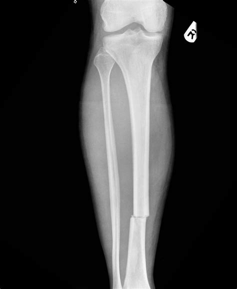 Pin On Types Of Fractures