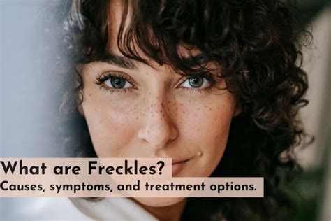 What Are Freckles Causes Symptoms And Treatment Options