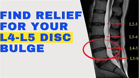 10 things l4 l5 disc bulge patients need to know for a speedy recovery
