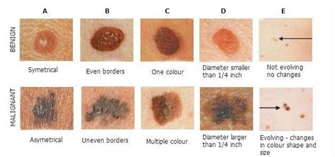 Moles And Raised Lesions — Nu Image Medical Esthetics