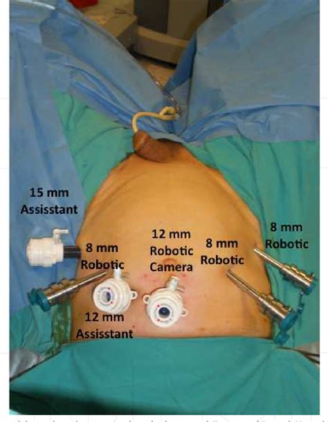 Figure 1 From Robotic Assisted Laparoscopic Radical Cystoprostatectomy
