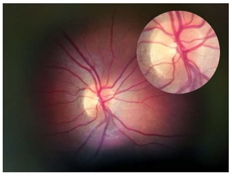 Retina And Optic Disc Image From Peek Retina Mark Vi Taken Through A