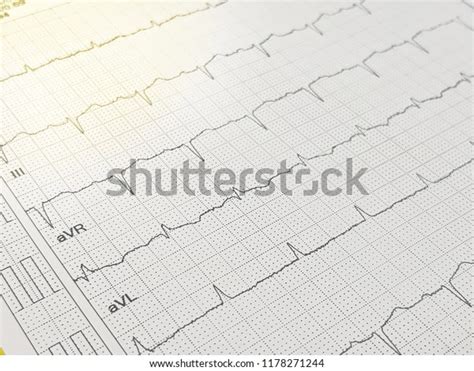 Electrocardiography Ecg Arrhythmia Cardiac Disease Atrial Stock Photo