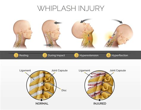 Ways Chiropractic Treats Whiplash Effectively And Successfully