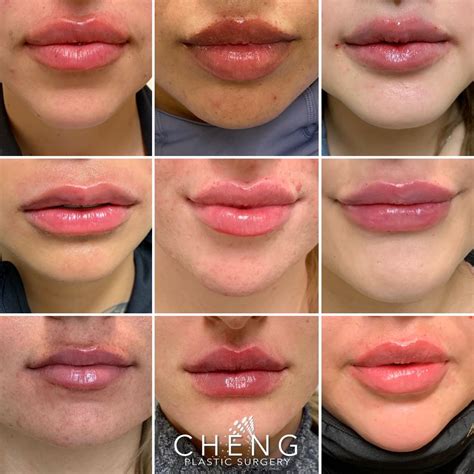 Different Lip Shapes With Fillers Lip