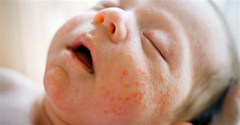 أسباب حساسية الجلد المفاجئة عند الأطفال وكيفية تجنبها ويب طب