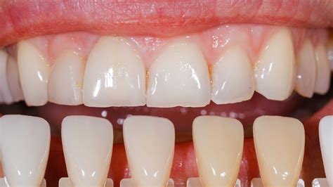 The Numerous Benefits Of Porcelain Dental Veneers Telegraph