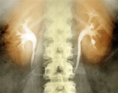 Spinal Cord And Normal Kidneys X Ray Stock Image C0271365