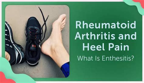 Rheumatoid Arthritis And Heel Pain What Is Enthesitis Myrateam