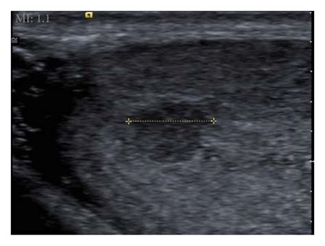 Gray Scale Ultrasound Image Reveals A Hypoechoic Solid Mass Within The